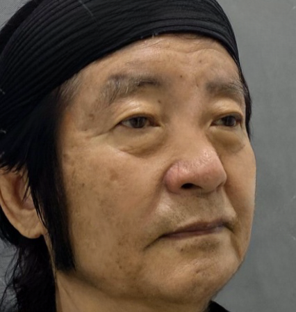 去眼袋手术