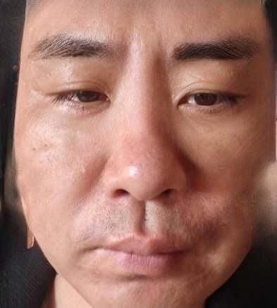 去眼袋手术