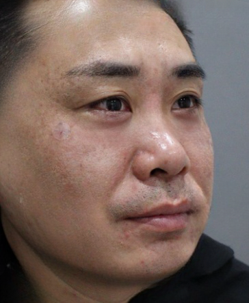 去眼袋手术