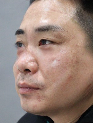 去眼袋手术