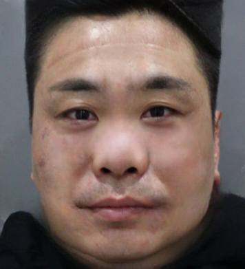 去眼袋手术