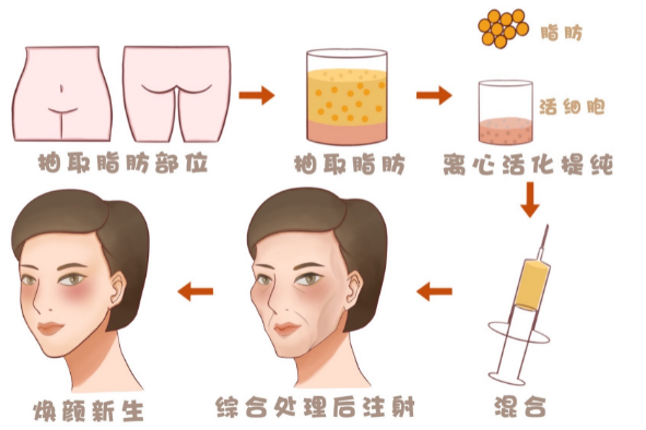 自体脂肪培养丰胸
