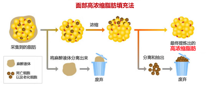 自体脂肪培养丰胸
