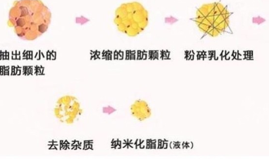 自体脂肪培养丰胸
