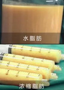 自体脂肪培养丰胸