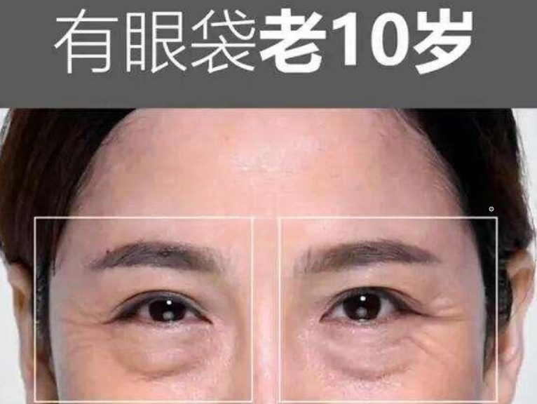眼袋