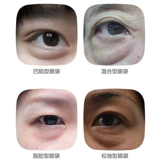 眼袋
