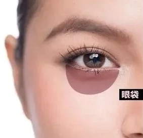 眼袋