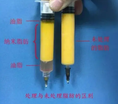 自体脂肪培养丰胸