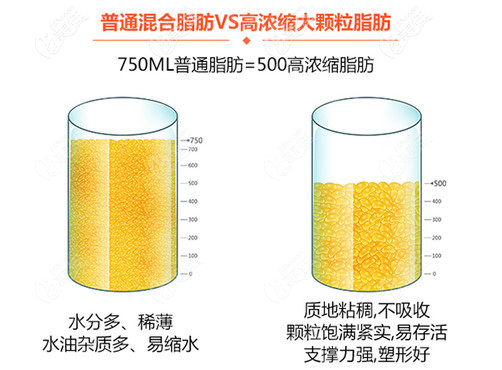 自体脂肪培养丰胸