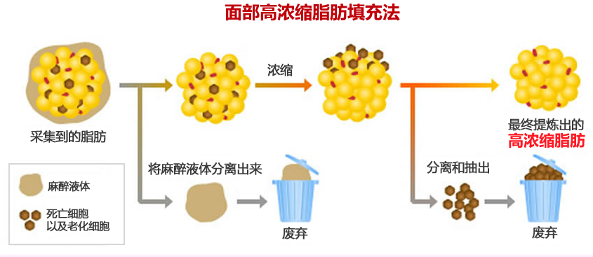 自体脂肪填充