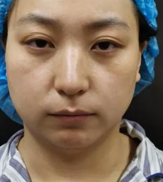 自体脂肪填充
