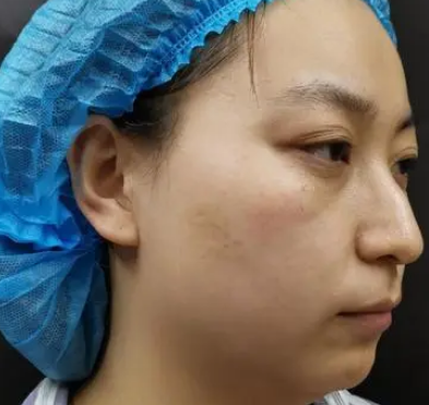 自体脂肪填充