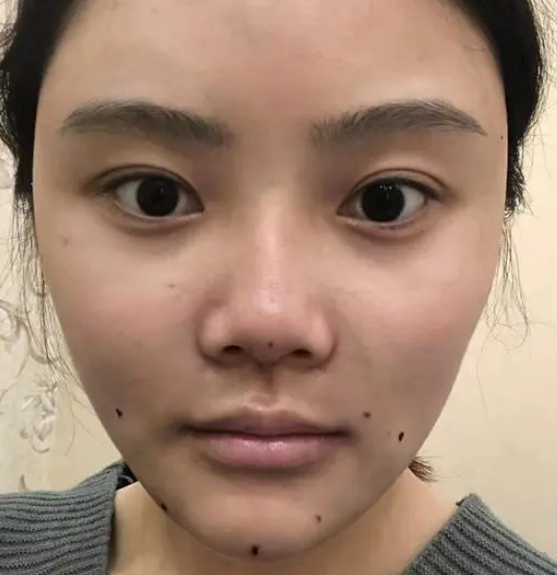自体脂肪填充