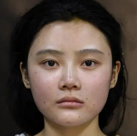 自体脂肪填充