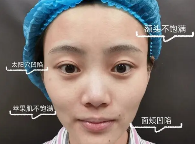 自体脂肪填充