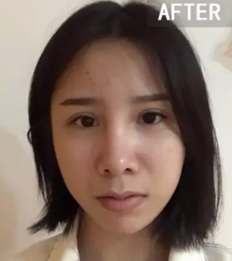 自体脂肪填充