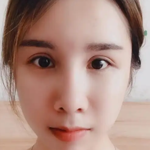 自体脂肪填充