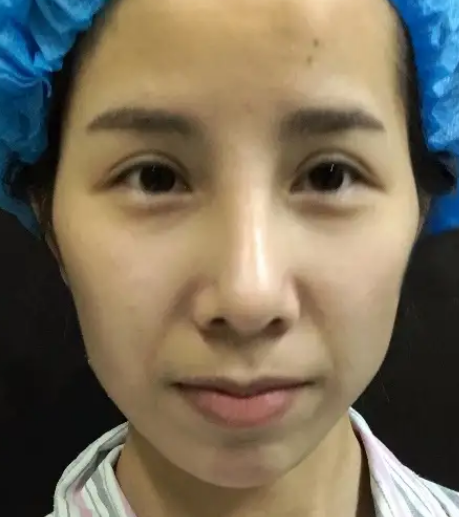 自体脂肪填充