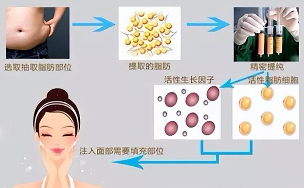 自体脂肪填充