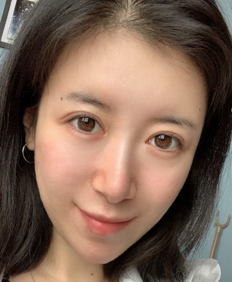 自体脂肪填充