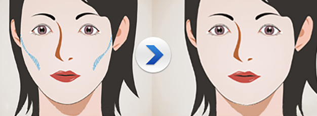 自体脂肪填充