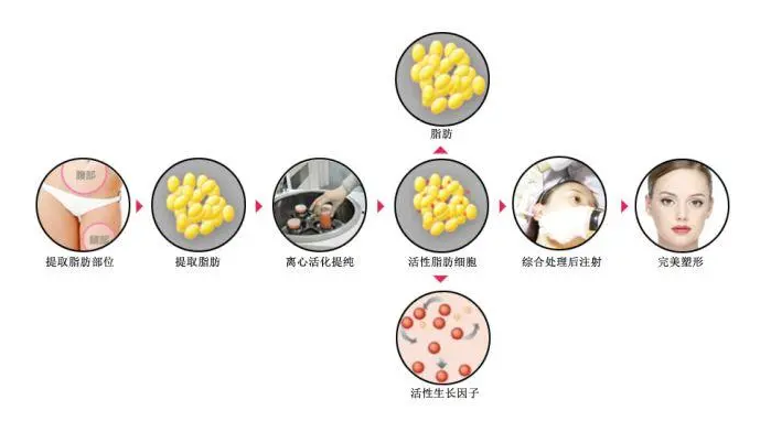 自体脂肪填充
