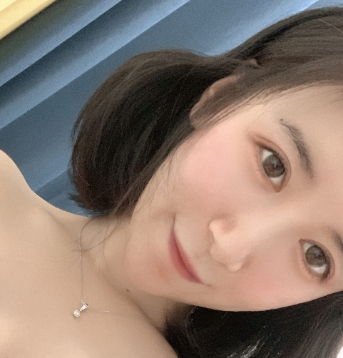 自体脂肪填充