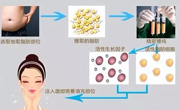 自体脂肪填充