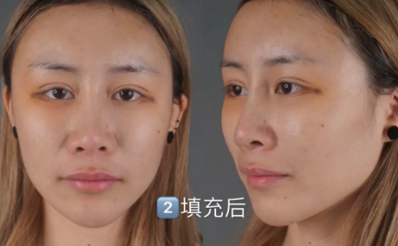 自体脂肪填充