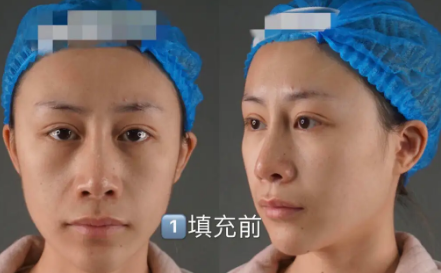 自体脂肪填充