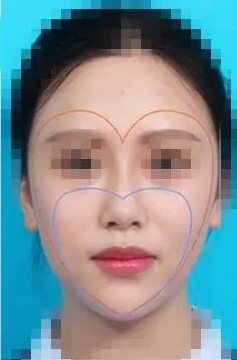 自体脂肪填充