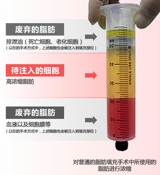 自体脂肪填充
