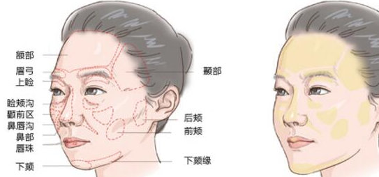 自体脂肪填充