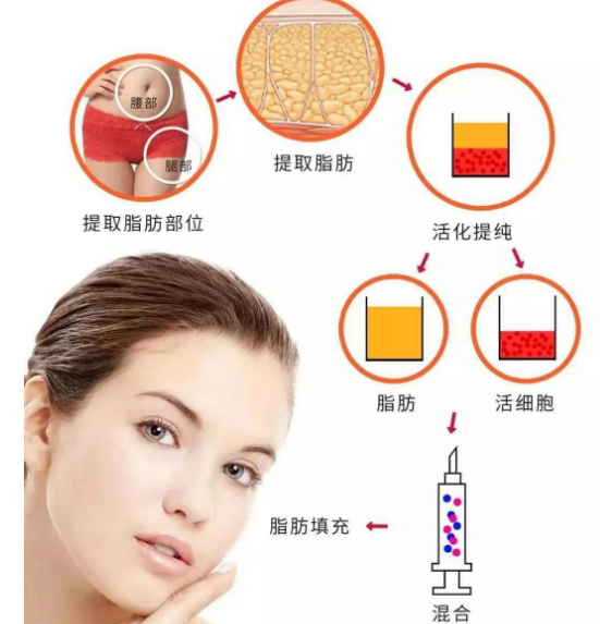 自体脂肪培养丰胸