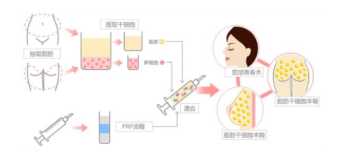 自体脂肪培养丰胸