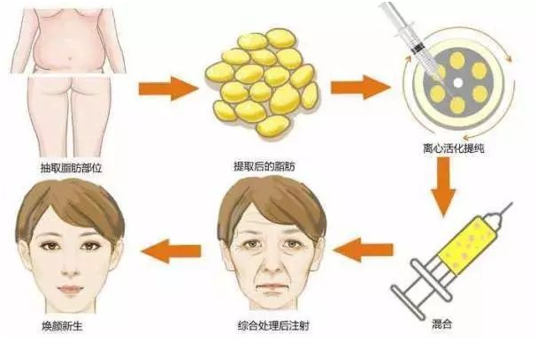 自体脂肪培养丰胸