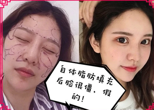 自体脂肪填充