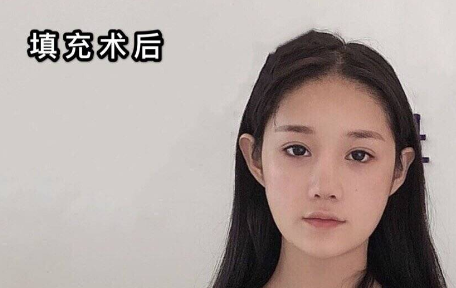 自体脂肪填充