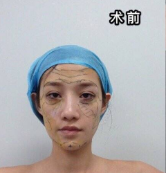 自体脂肪填充