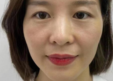 自体脂肪填充