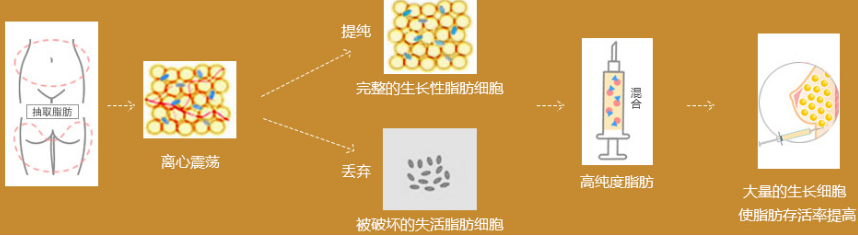自体脂肪培养丰胸