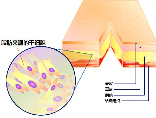 自体脂肪培养丰胸