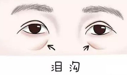 泪沟
