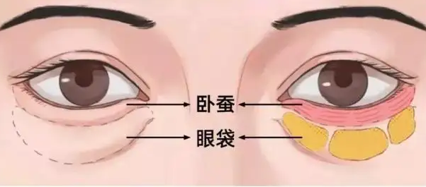 泪沟