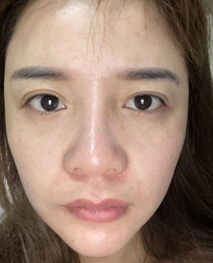 眼袋手术
