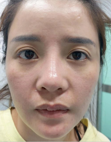 眼袋手术