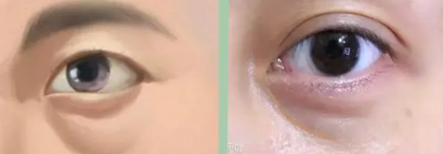 眼袋手术