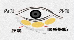 眼袋手术
