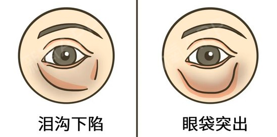 眼袋手术